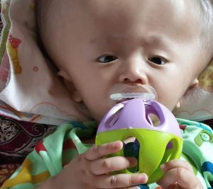 Bocah Enam Tahun Penderita Hidrosepalus di Abung Tinggi Terima Bantuan