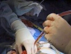 Angka Kematian Tinggi, Kemenkes Bentuk Tim Selidiki Penyakit Gagal Ginjal Akut pada Anak