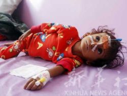 Kekurangan Dana, WFP akan Tangguhkan Intervensi Gizi Buruk di Yaman