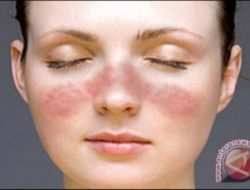 Prof. Heru Sundaru: Kenali Gejala Lupus dan Segera Lakukan Pemeriksaan